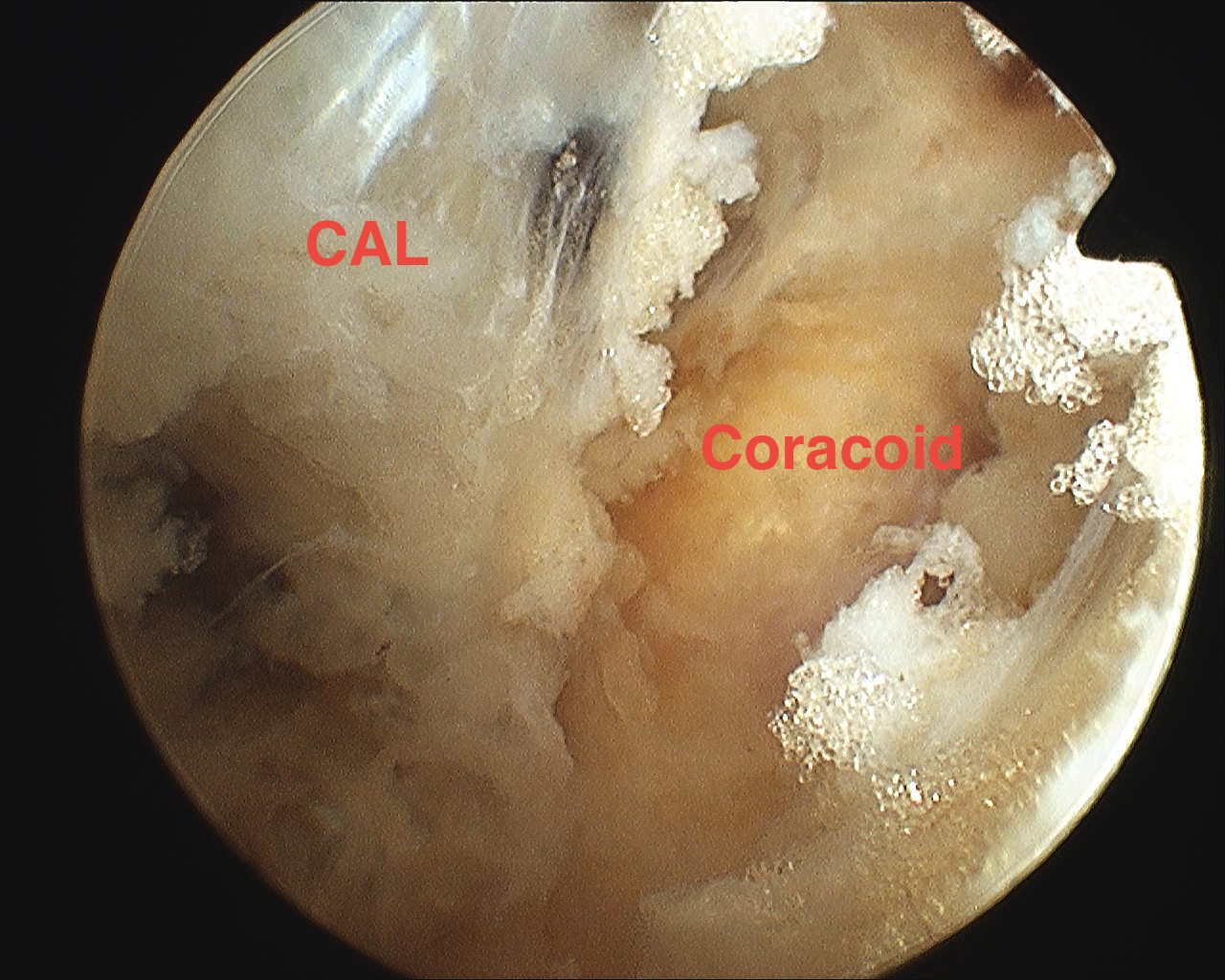 SSN Release Coracoid and CHL